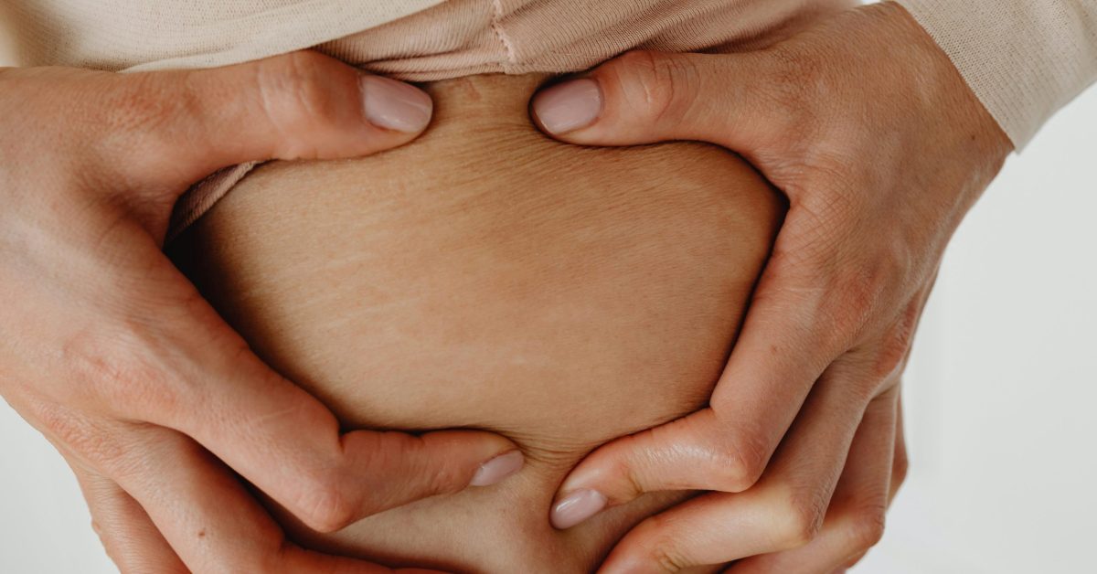 Can You Really Tattoo Over Stretch Marks?